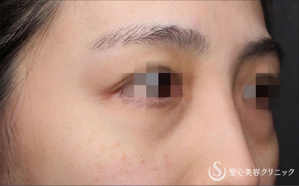【30代女性・目の下のクマ】経結膜下脱脂術（術後1ヶ月） Before 