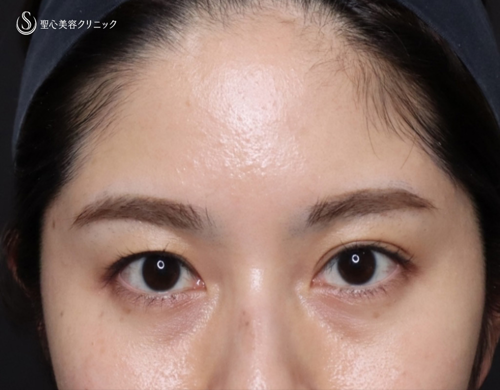【20代女性・額をふっくら＆目の下のクマ治療】プレミアムPRP皮膚再生療法（6ヶ月後） Before 