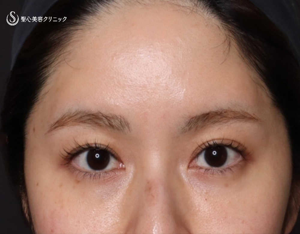 【20代女性・額をふっくら＆目の下のクマ治療】プレミアムPRP皮膚再生療法（6ヶ月後） After 