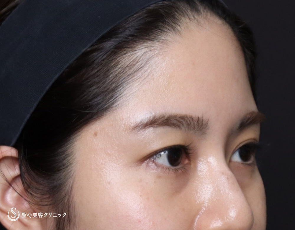 【20代女性・額をふっくら＆目の下のクマ治療】プレミアムPRP皮膚再生療法（6ヶ月後） Before 