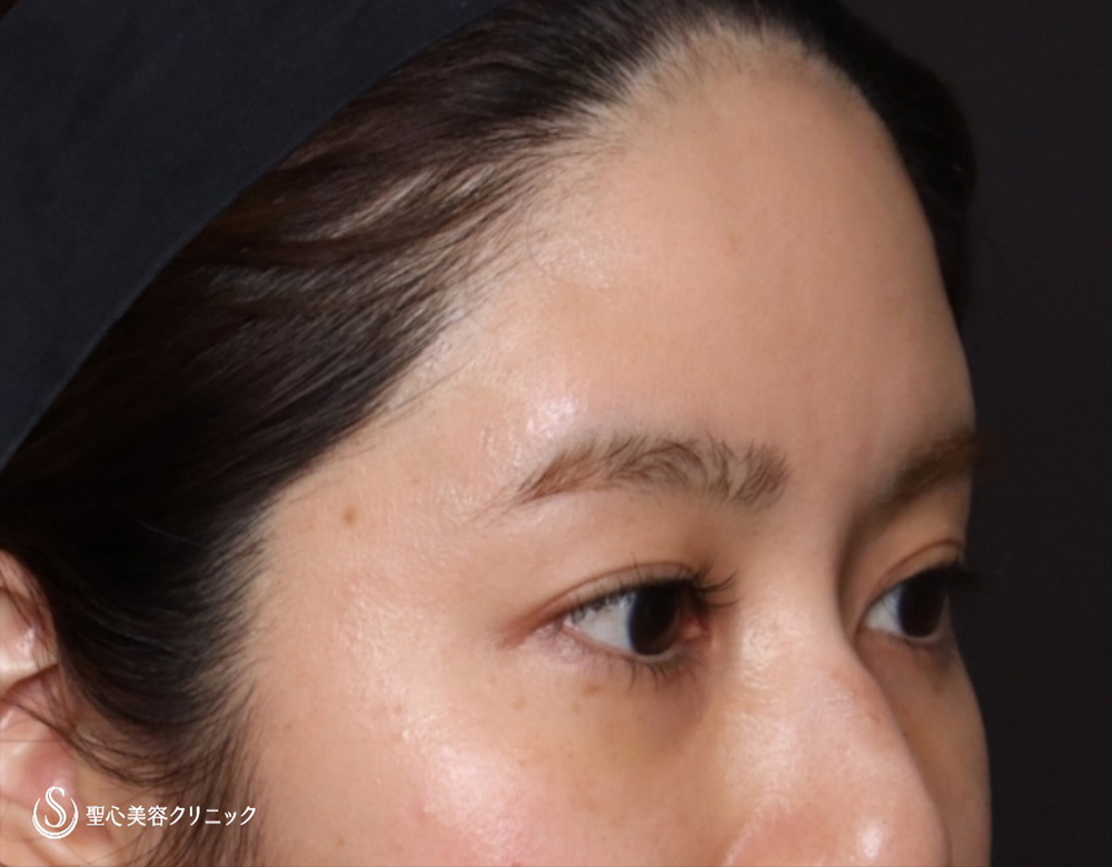 【20代女性・額をふっくら＆目の下のクマ治療】プレミアムPRP皮膚再生療法（6ヶ月後） After 
