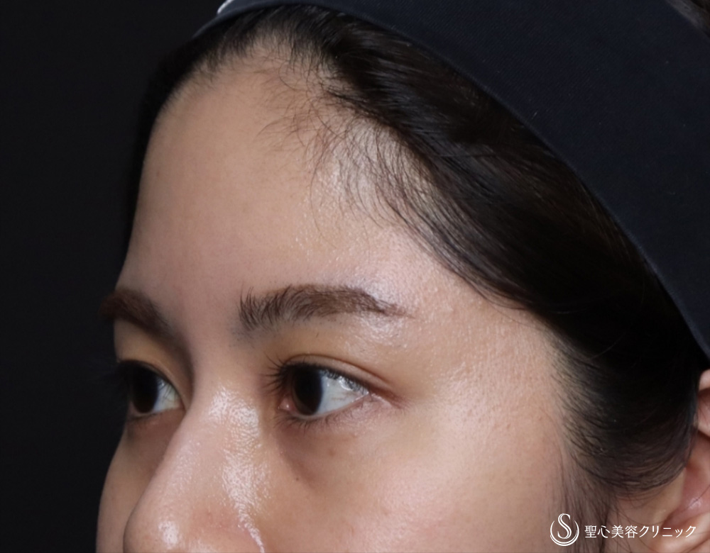 【20代女性・額をふっくら＆目の下のクマ治療】プレミアムPRP皮膚再生療法（6ヶ月後） Before 