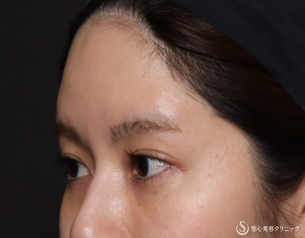 【20代女性・額をふっくら＆目の下のクマ治療】プレミアムPRP皮膚再生療法（6ヶ月後） After 