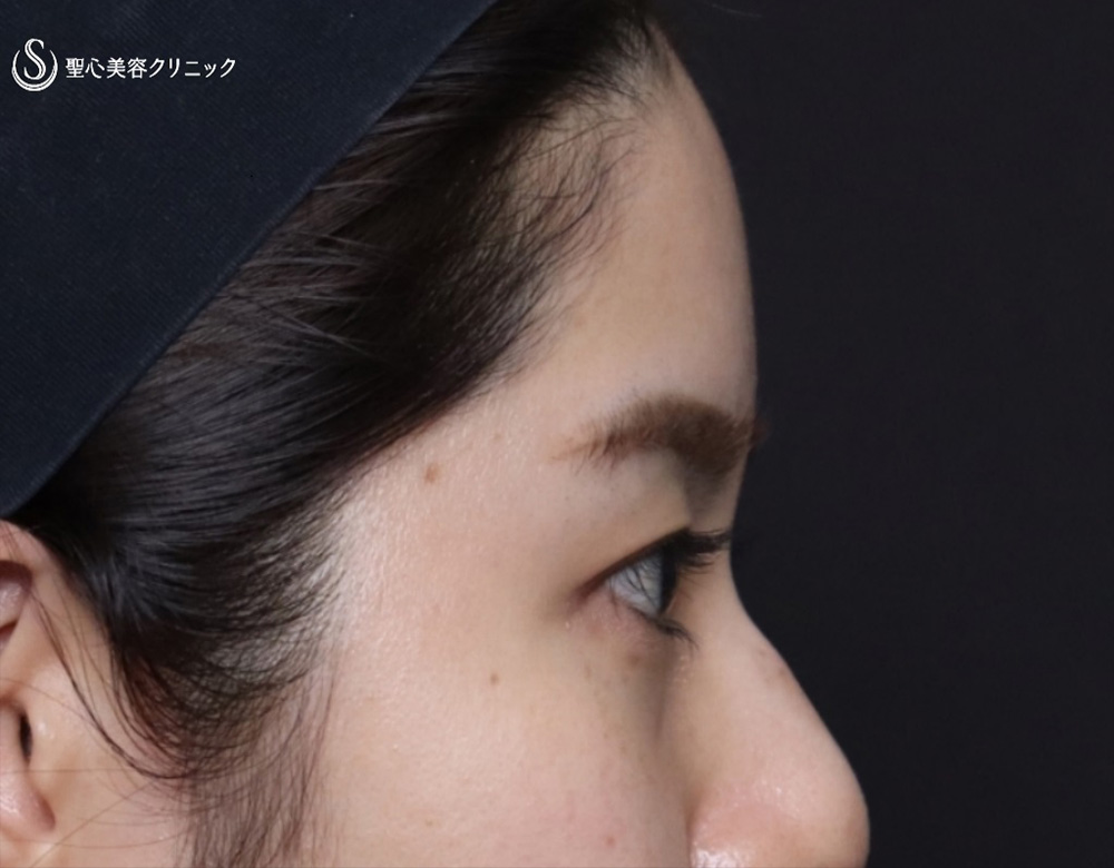 【20代女性・額をふっくら＆目の下のクマ治療】プレミアムPRP皮膚再生療法（6ヶ月後） Before 