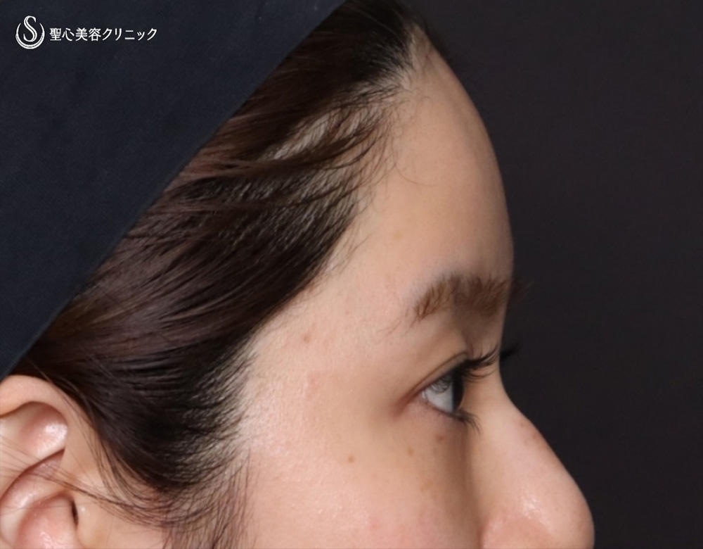 【20代女性・額をふっくら＆目の下のクマ治療】プレミアムPRP皮膚再生療法（6ヶ月後） After 