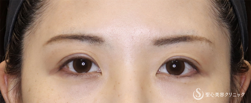 【20代女性・埋没で取れてしまう二重ラインに】二重術（切開法）（術後3ヶ月） After 