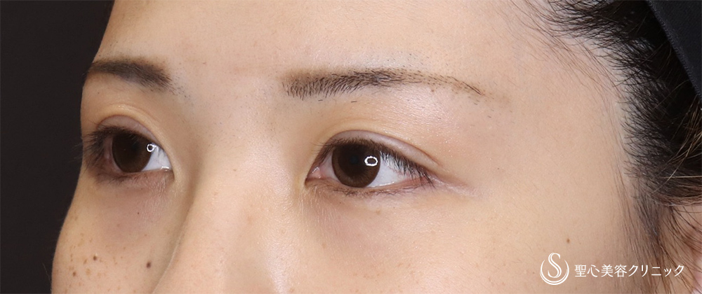 【20代女性・埋没で取れてしまう二重ラインに】二重術（切開法）（術後3ヶ月） After 