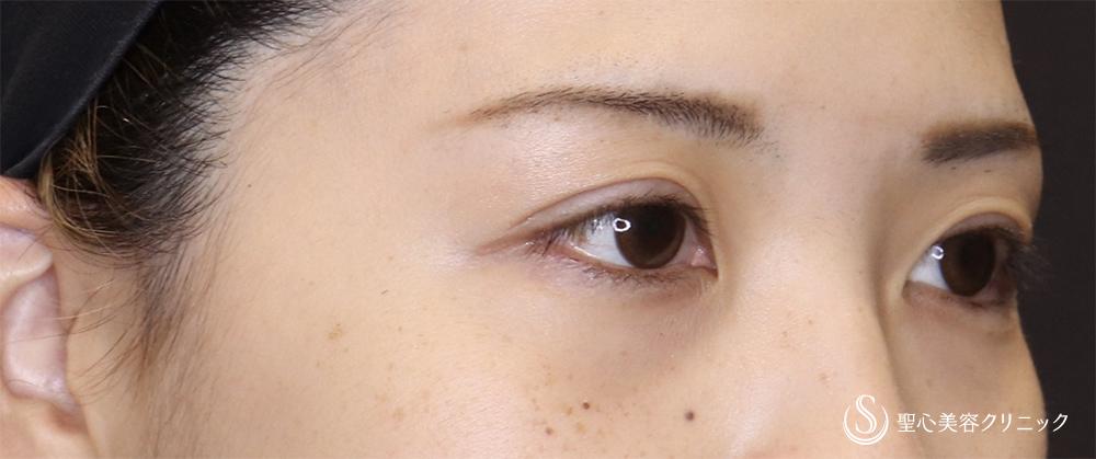 【20代女性・埋没で取れてしまう二重ラインに】二重術（切開法）（術後3ヶ月） After 