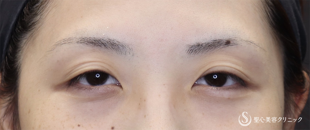 【20代女性・埋没で取れてしまう二重ラインに】二重術（切開法）（術後3ヶ月） Before 