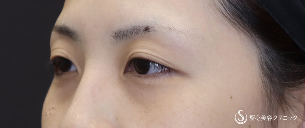 【20代女性・埋没で取れてしまう二重ラインに】二重術（切開法）（術後3ヶ月） Before 