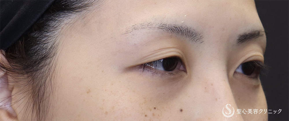 【20代女性・埋没で取れてしまう二重ラインに】二重術（切開法）（術後3ヶ月） Before 