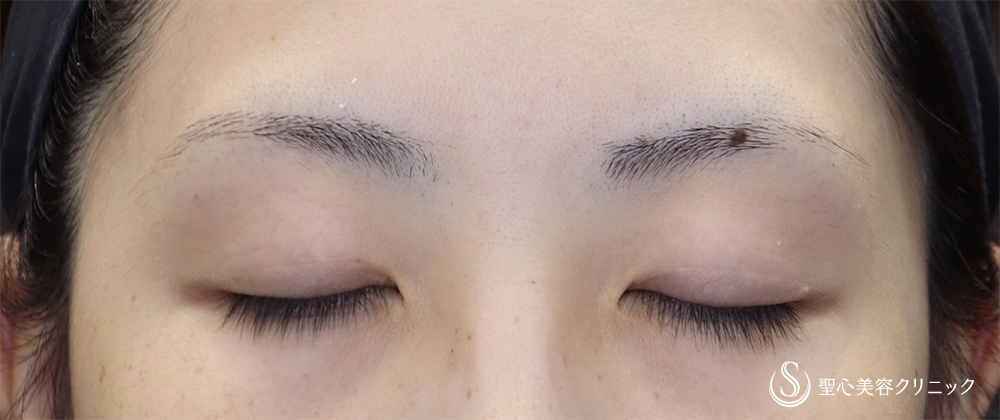 【20代女性・埋没で取れてしまう二重ラインに】二重術（切開法）（術後3ヶ月） Before 