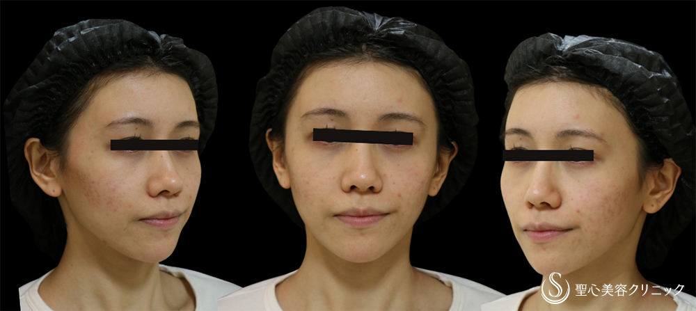 【20代女性・卵型の顔に】プレミアムPRP皮膚再生療法＋ボトックスリフト＋ヒアルロン酸注入＋ボトックス注入（6週間後） After 