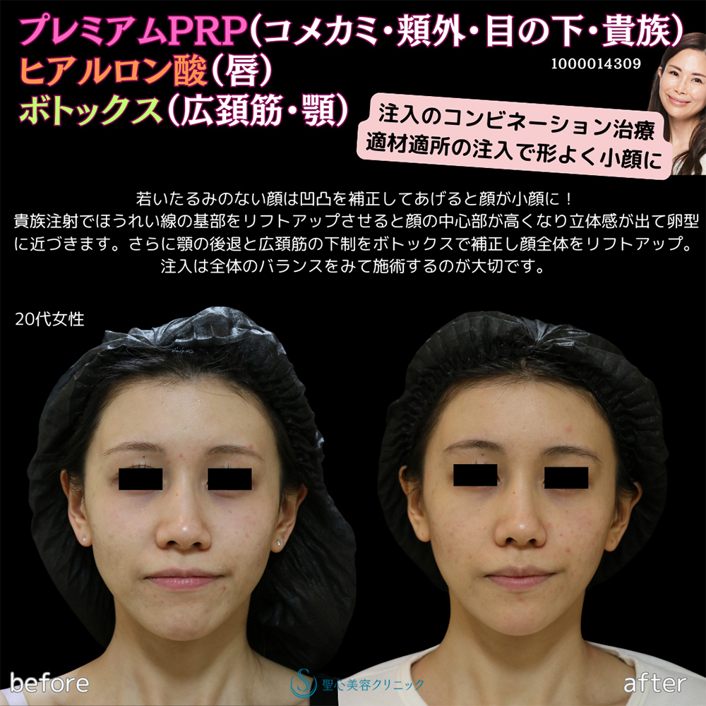 【20代女性・卵型の顔に】プレミアムPRP皮膚再生療法＋ボトックスリフト＋ヒアルロン酸注入＋ボトックス注入（6週間後） After 