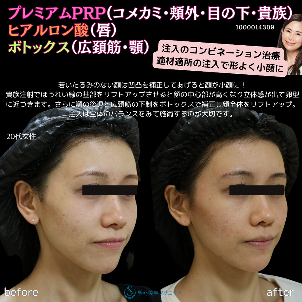 【20代女性・卵型の顔に】プレミアムPRP皮膚再生療法＋ボトックスリフト＋ヒアルロン酸注入＋ボトックス注入（6週間後） After 