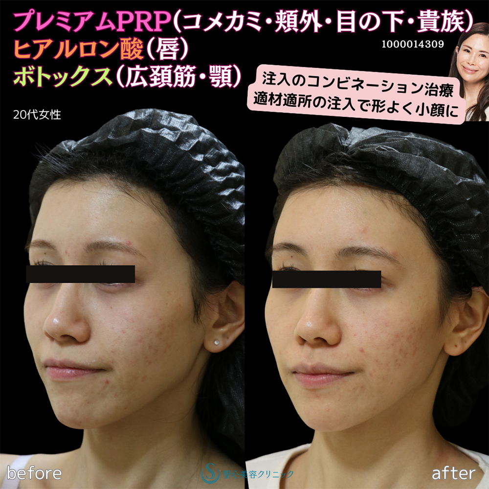 【20代女性・卵型の顔に】プレミアムPRP皮膚再生療法＋ボトックスリフト＋ヒアルロン酸注入＋ボトックス注入（6週間後） After 