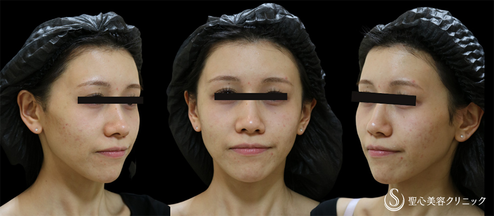 【20代女性・卵型の顔に】プレミアムPRP皮膚再生療法＋ボトックスリフト＋ヒアルロン酸注入＋ボトックス注入（6週間後） Before 