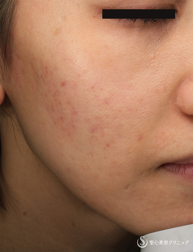 【20代女性・ニキビ】ナノメッド VA エッセンス外用（1.5ヵ月後） After 