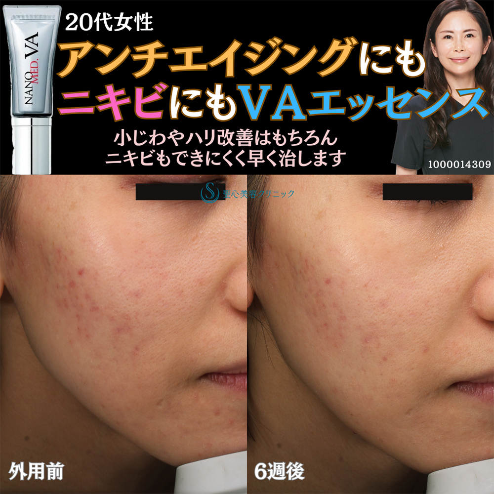 【20代女性・ニキビ】ナノメッド VA エッセンス外用（1.5ヵ月後） After 