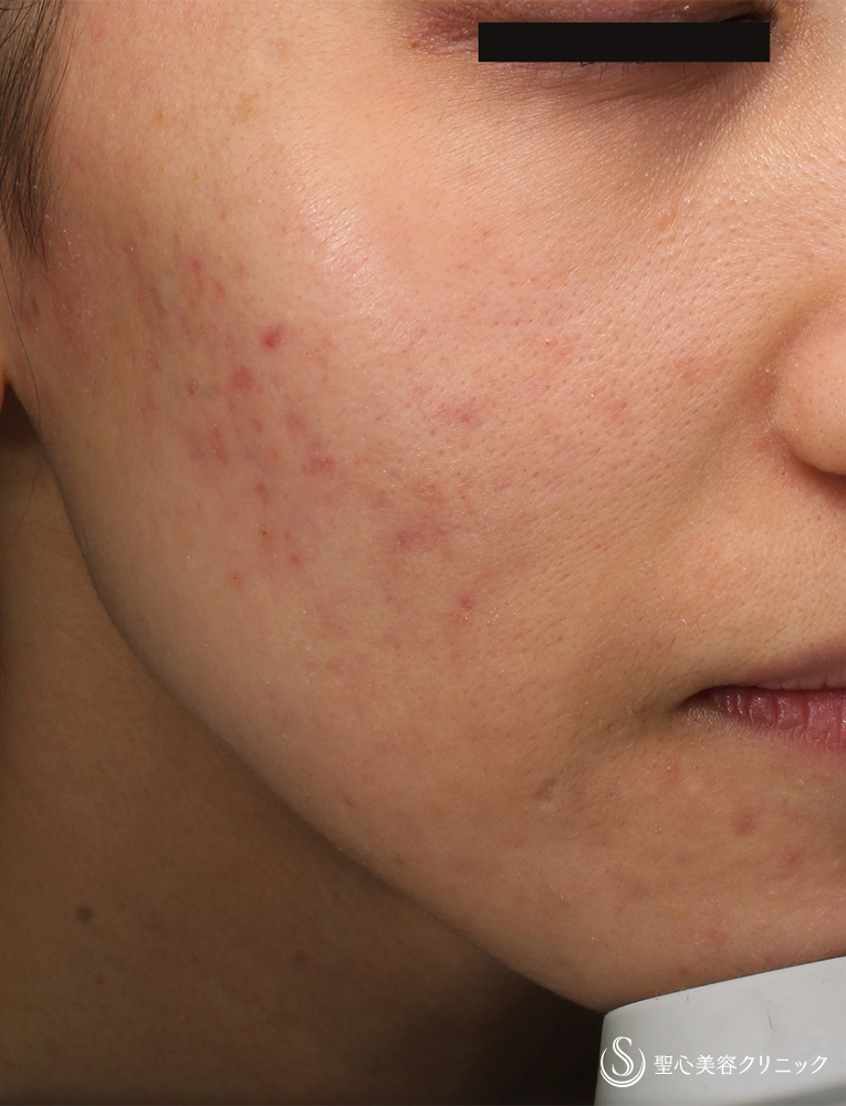 【20代女性・ニキビ】ナノメッド VA エッセンス外用（1.5ヵ月後） Before 