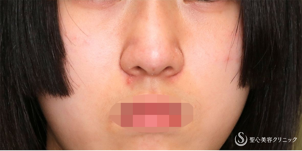 【10代女性・自然な忘れ鼻に】小鼻縮小術（内側）＋G-Mesh（3本）＋鼻尖縮小＋鼻尖形成（耳介軟骨移植）（3週間後） After 名古屋　名古屋駅　鼻整形　忘れ鼻　鼻フル