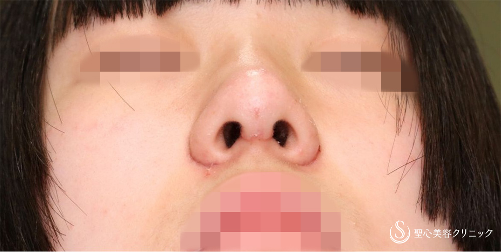 【10代女性・自然な忘れ鼻に】小鼻縮小術（内側）＋G-Mesh（3本）＋鼻尖縮小＋鼻尖形成（耳介軟骨移植）（3週間後） After 名古屋　名古屋駅　鼻整形　忘れ鼻　鼻フル