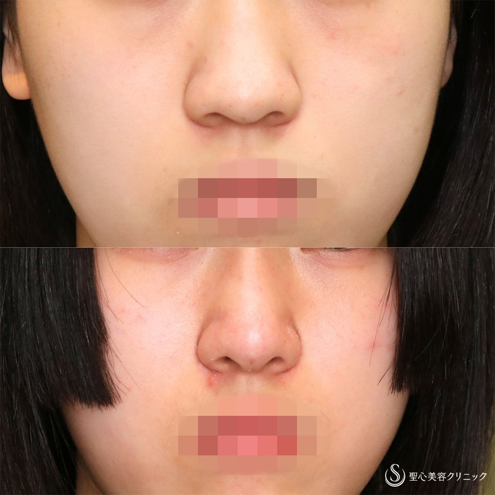 【10代女性・自然な忘れ鼻に】小鼻縮小術（内側）＋G-Mesh（3本）＋鼻尖縮小＋鼻尖形成（耳介軟骨移植）（3週間後） After 名古屋　名古屋駅　鼻整形　忘れ鼻　鼻フル