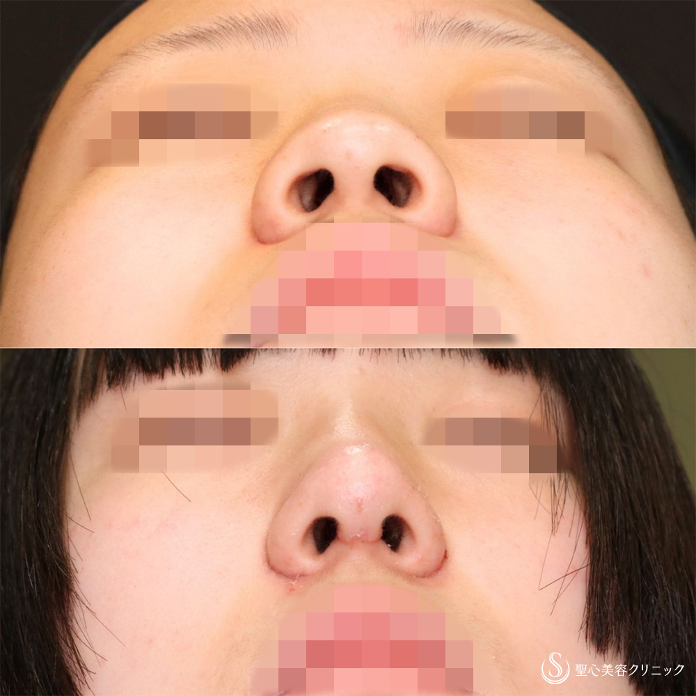 【10代女性・自然な忘れ鼻に】小鼻縮小術（内側）＋G-Mesh（3本）＋鼻尖縮小＋鼻尖形成（耳介軟骨移植）（3週間後） After 名古屋　名古屋駅　鼻整形　忘れ鼻　鼻フル