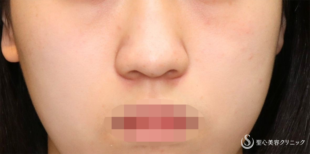 【10代女性・自然な忘れ鼻に】小鼻縮小術（内側）＋G-Mesh（3本）＋鼻尖縮小＋鼻尖形成（耳介軟骨移植）（3週間後） Before 10代女性・自然な忘れ鼻に