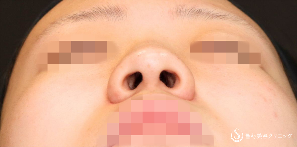 【10代女性・自然な忘れ鼻に】小鼻縮小術（内側）＋G-Mesh（3本）＋鼻尖縮小＋鼻尖形成（耳介軟骨移植）（3週間後） Before 