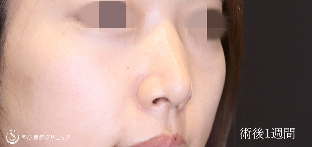 【20代女性・切り上がりのある鼻の穴を目立ちにくく】 鼻孔縁下降術（1週間後） After 