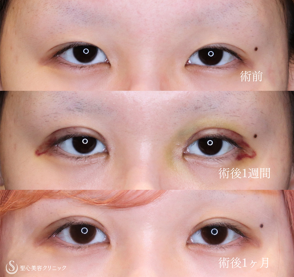【10代女性・自然な平行二重に】二重術（切開法）＋目上切開（1ヶ月後） After 