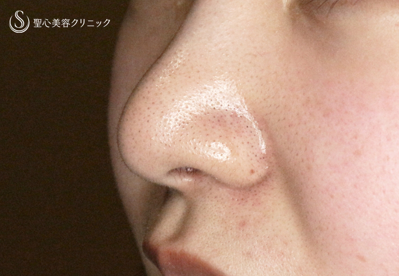 【18歳女性・最小限の切開で「忘れ鼻」】小鼻縮小術+α法「Ver.7.5」（直後〜1年1ヶ月後） After 