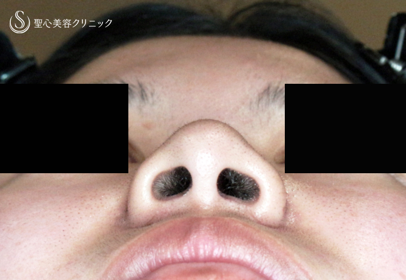 【18歳女性・最小限の切開で「忘れ鼻」】小鼻縮小術+α法「Ver.7.5」（直後〜1年1ヶ月後） After 