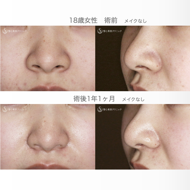 【18歳女性・最小限の切開で「忘れ鼻」】小鼻縮小術+α法「Ver.7.5」（直後〜1年1ヶ月後） After 