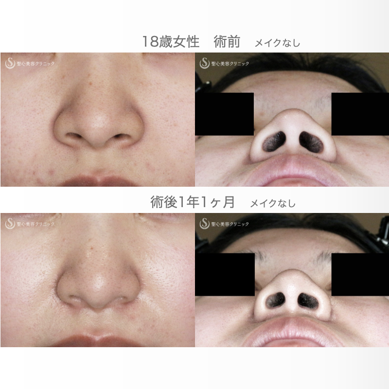 【18歳女性・最小限の切開で「忘れ鼻」】小鼻縮小術+α法「Ver.7.5」（直後〜1年1ヶ月後） After 