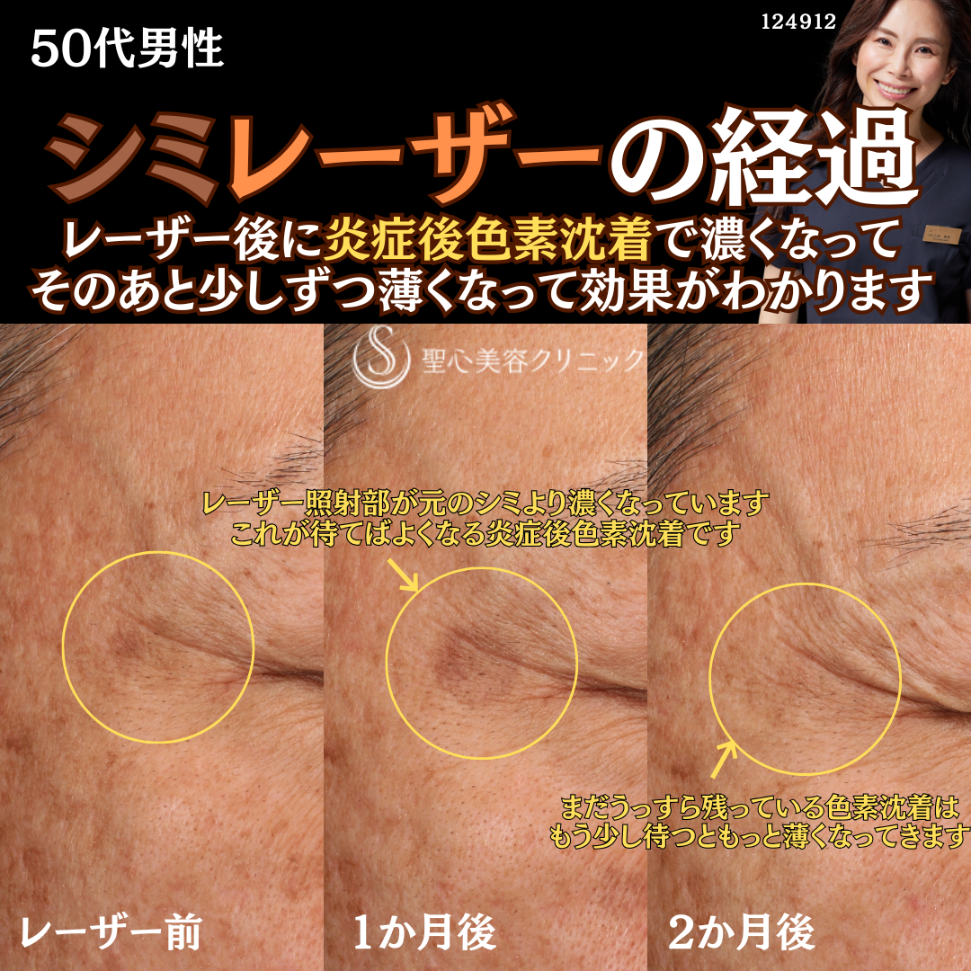 【50代男性・顔のシミ】532フラクショナルレーザー（2ヶ月後） After 
