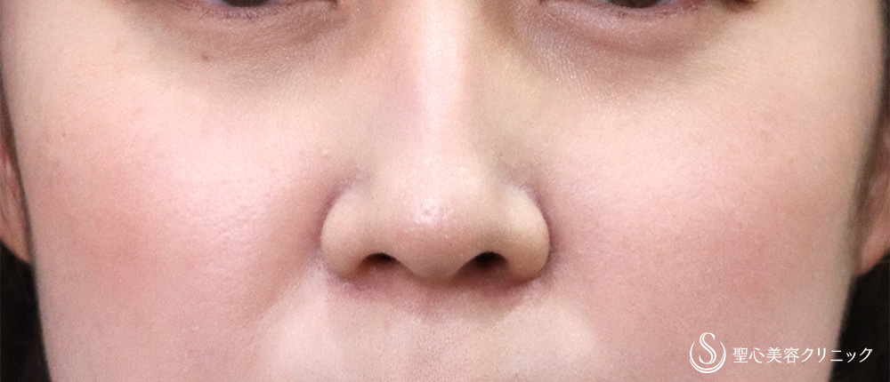 【40代女性・目の下の膨らみを改善】目の下の脂肪取り（経結膜下脱脂法）（1ヶ月後） After 