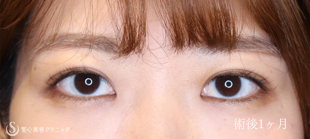 【20代女性・埋没法でスッキリしたお目元に】マイクロメソッド+α（二重埋没法）（1ヶ月後） After 