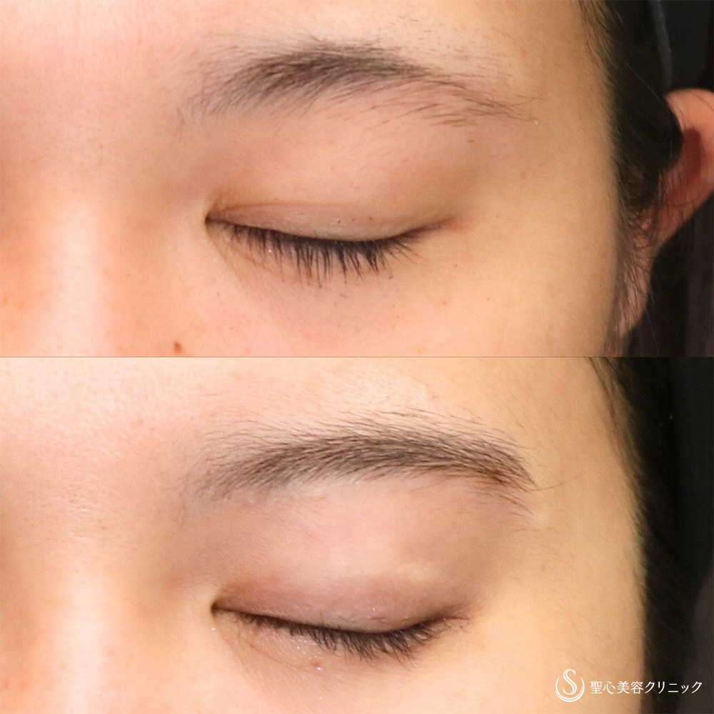 【20代女性・傷跡が目立たない切開】眉下切開法（約6ヶ月後） After 名古屋院・二重・スッキリ