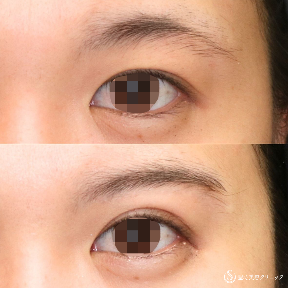 【20代女性・傷跡が目立たない切開】眉下切開法（約6ヶ月後） After 名古屋院・二重・スッキリ