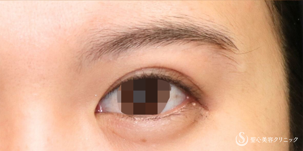 【20代女性・傷跡が目立たない切開】眉下切開法（約6ヶ月後） After 