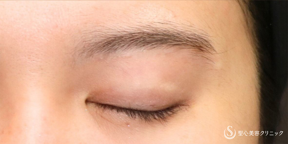 【20代女性・傷跡が目立たない切開】眉下切開法（約6ヶ月後） After 