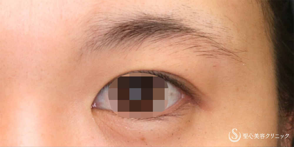 【20代女性・傷跡が目立たない切開】眉下切開法（約6ヶ月後） Before 