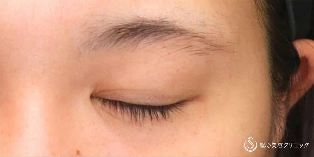 【20代女性・傷跡が目立たない切開】眉下切開法（約6ヶ月後） Before 