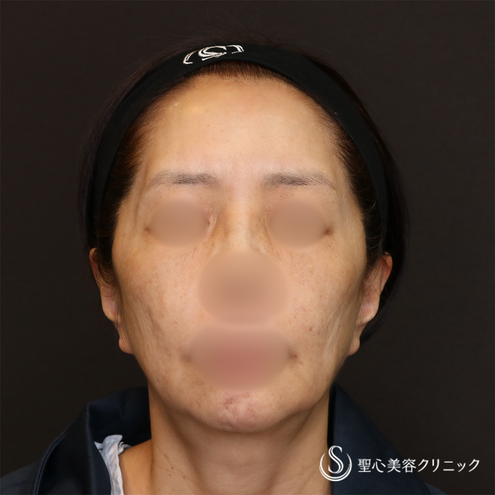 【60代女性・抜群の若返り効果】フェイスリフト＋顎下、頬の脂肪吸引＋リガメント処置（4週間後） Before 