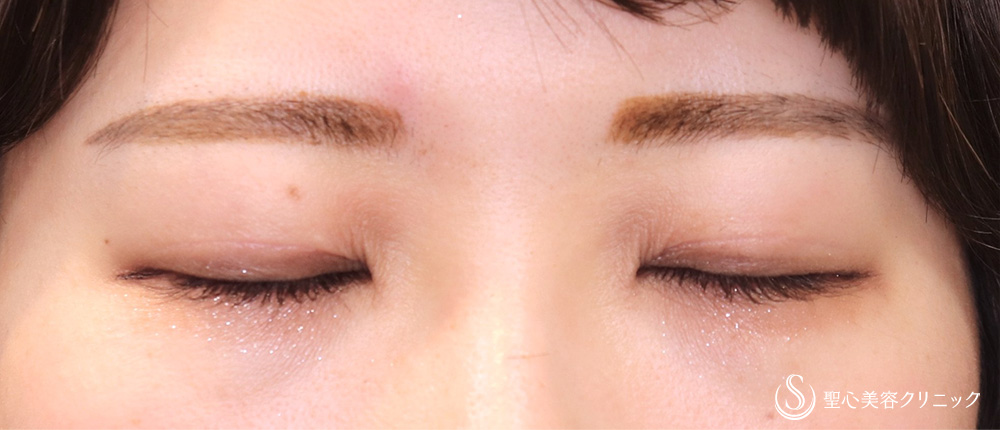 【20代女性・眼瞼下垂手術で目の開きを改善】眼瞼下垂（切開法／挙筋前転法）（3ヶ月後） After 
