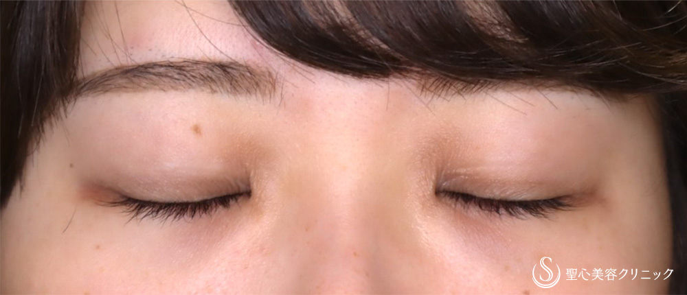 【20代女性・眼瞼下垂手術で目の開きを改善】眼瞼下垂（切開法／挙筋前転法）（3ヶ月後） Before 