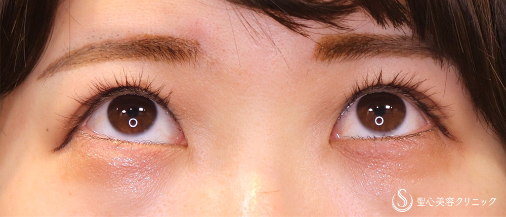 【20代女性・眼瞼下垂手術で目の開きを改善】眼瞼下垂（切開法／挙筋前転法）（3ヶ月後） After 