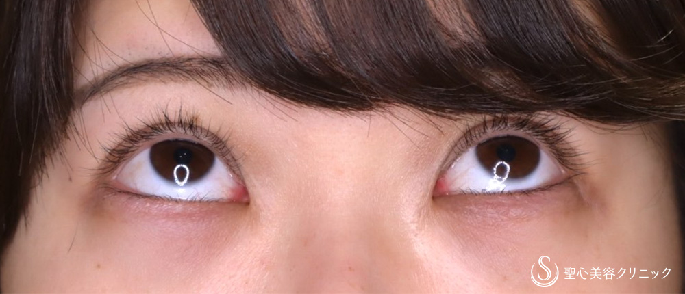 【20代女性・眼瞼下垂手術で目の開きを改善】眼瞼下垂（切開法／挙筋前転法）（3ヶ月後） Before 